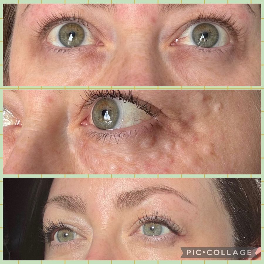 Biostimulator treatment result, before and after