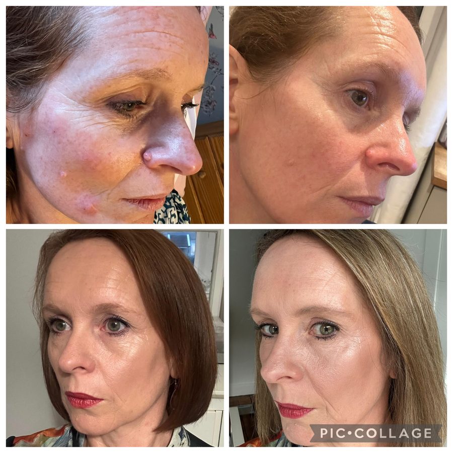 Combination treatment result, before and after