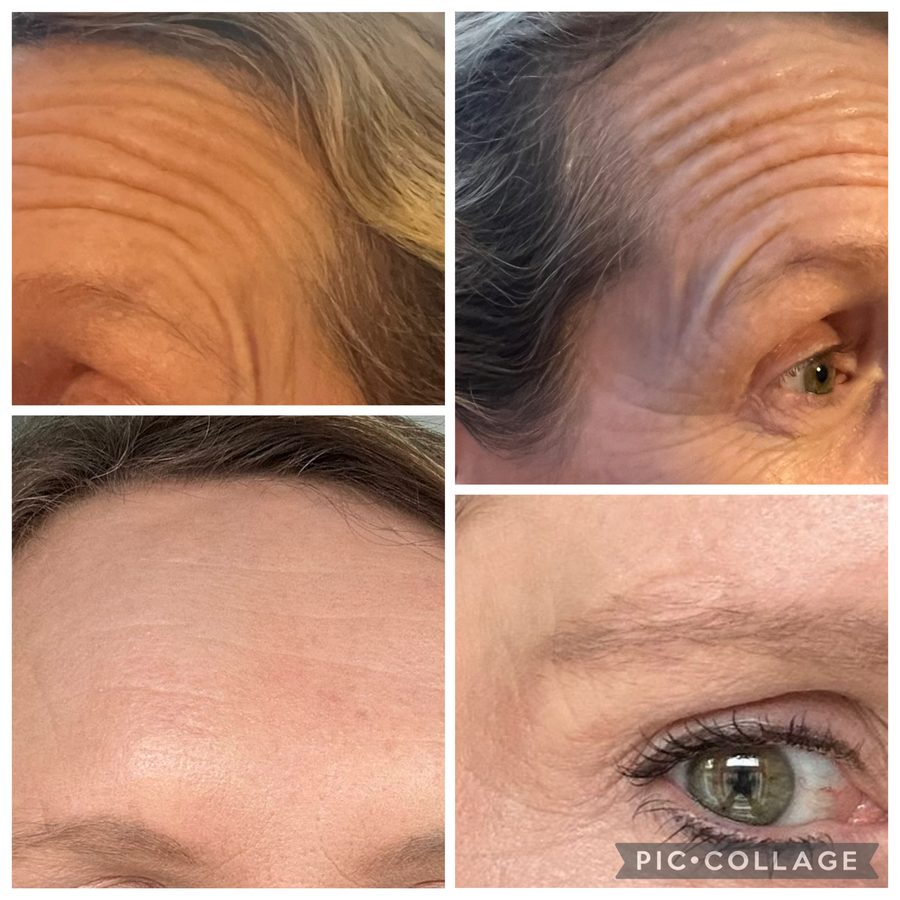 Neuromodulator treatment result, before and after